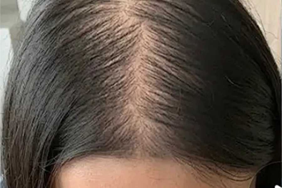 Hair Growth Serum-before